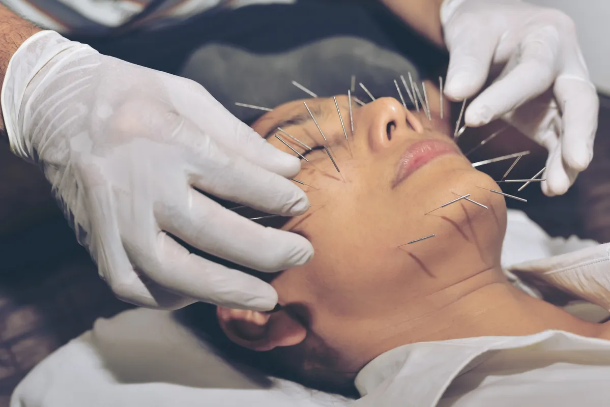 Face acupuncture. Asian Woman undergoing acupuncture treatment.